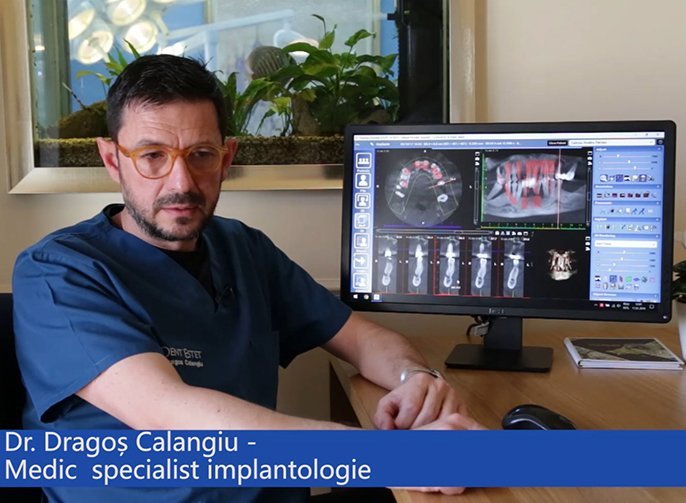 Implantul Straumann PRO Arch®