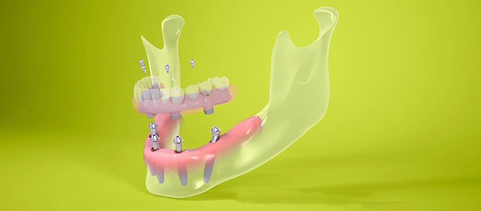 Implantul Straumann PRO Arch®