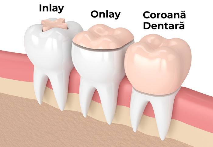 Incrustațiile dentare