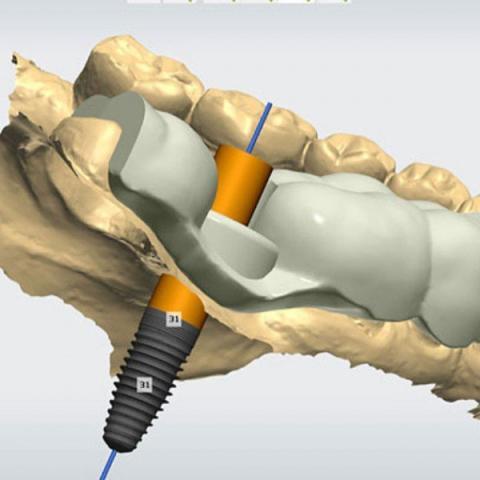 Digitally guided PERFORMANT dental implant