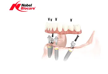 Sistemul de implant dentar All-on-4®