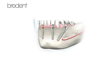Bredent® Fast & Fixed - sistem 4-6 implanturi