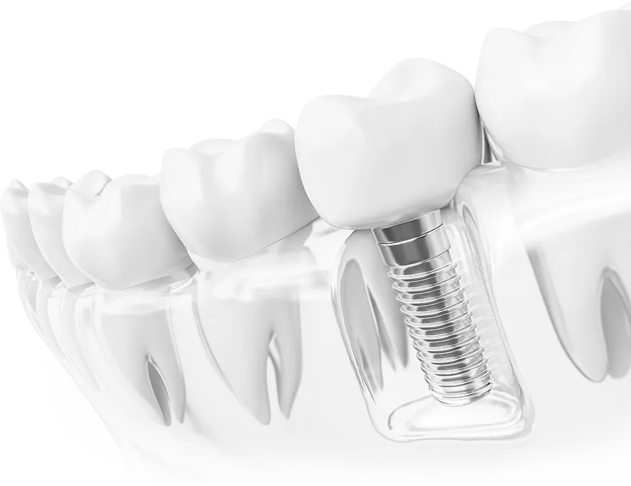 Implant dentar Implant dentar