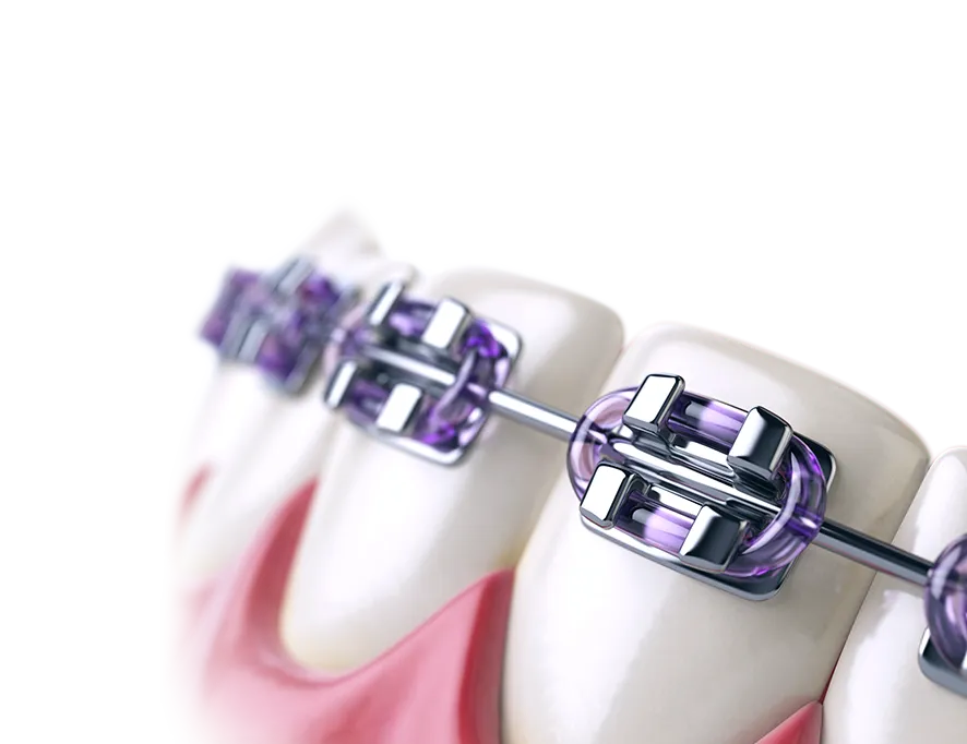 Aparat dentar - Ortodonție Aparat dentar - Ortodonție