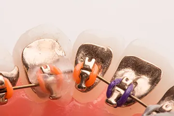 Aparat dentar invizibil (lingual) Incognito