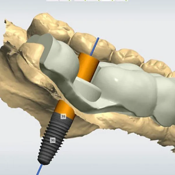Digitally guided PERFORMANT dental implant